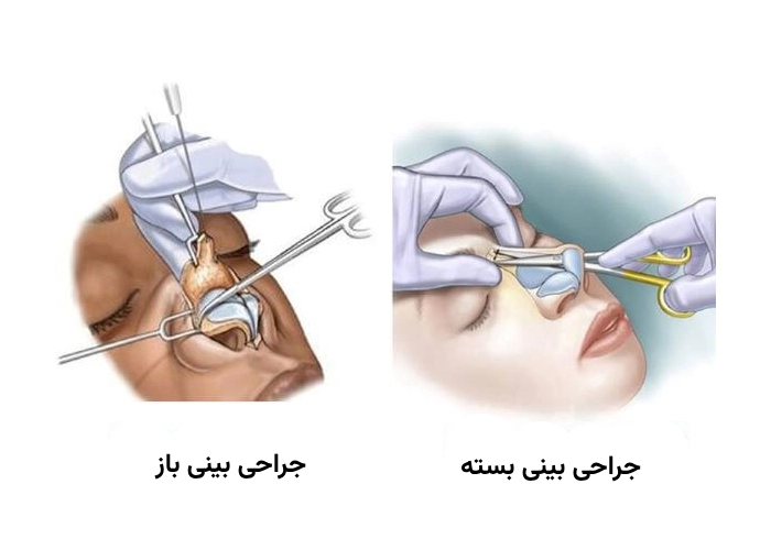 بهترین جراح زیبایی بینی در تهران -روش های عمل زیبایی بینی