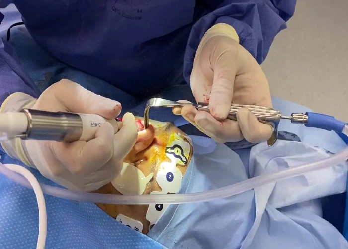 جدیدترین روش جراحی بینی توسط بهترین جراح زیبایی بینی در تهران