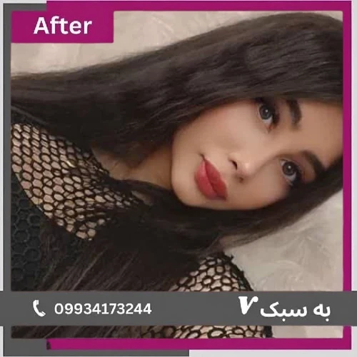 بینی استخوانی با نتیجه نیمه فانتزی طبیعی؛ دکتر آرزو خوانساری‌نیا | بهترین جراح بینی نیمه فانتزی در تهران