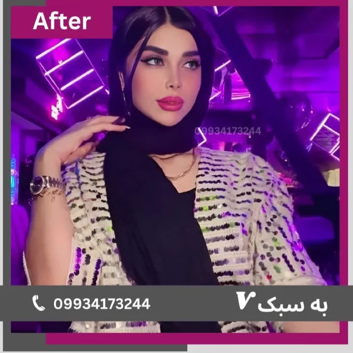 بینی گوشتی با فرم نیمه فانتزی؛ دکتر آرزو خوانساری‌نیا | بهترین جراح بینی نیمه فانتزی در تهران