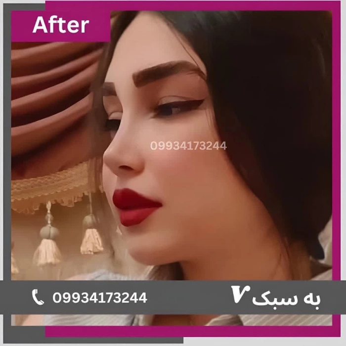 قبل و بعد نیمه فانتزی؛ دکتر آرزو خوانساری‌نیا | بهترین جراح بینی نیمه فانتزی در تهران