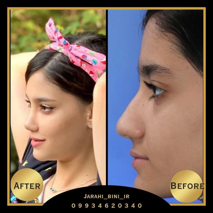 قبل و بعد نیمه فانتزی؛ دکتر اکبر اعتمادی | بهترین جراح بینی نیمه فانتزی در تهران