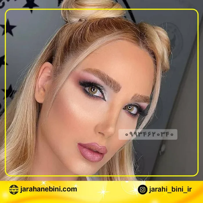 بینی گوشتی نیمه فانتزی؛ دکتر اکبر اعتمادی | بهترین جراح بینی نیمه فانتزی در تهران