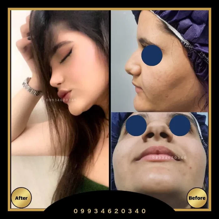 فرم نیمه فانتزی هماهنگ با چهره؛ دکتر اکبر اعتمادی | بهترین جراح بینی نیمه فانتزی در تهران