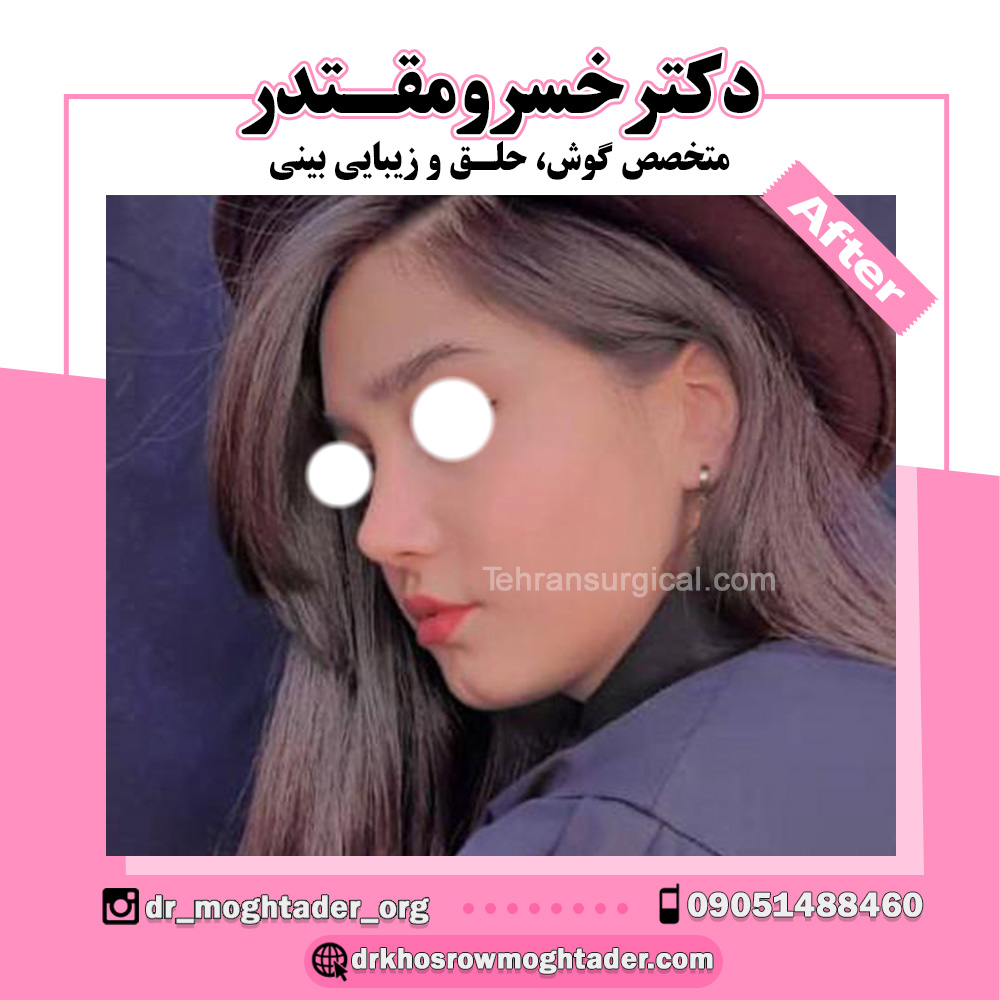 اصلاح قوز و تیپ نیمه فانتزی؛ دکتر خسرو مقتدر | بهترین جراح بینی نیمه فانتزی در تهران