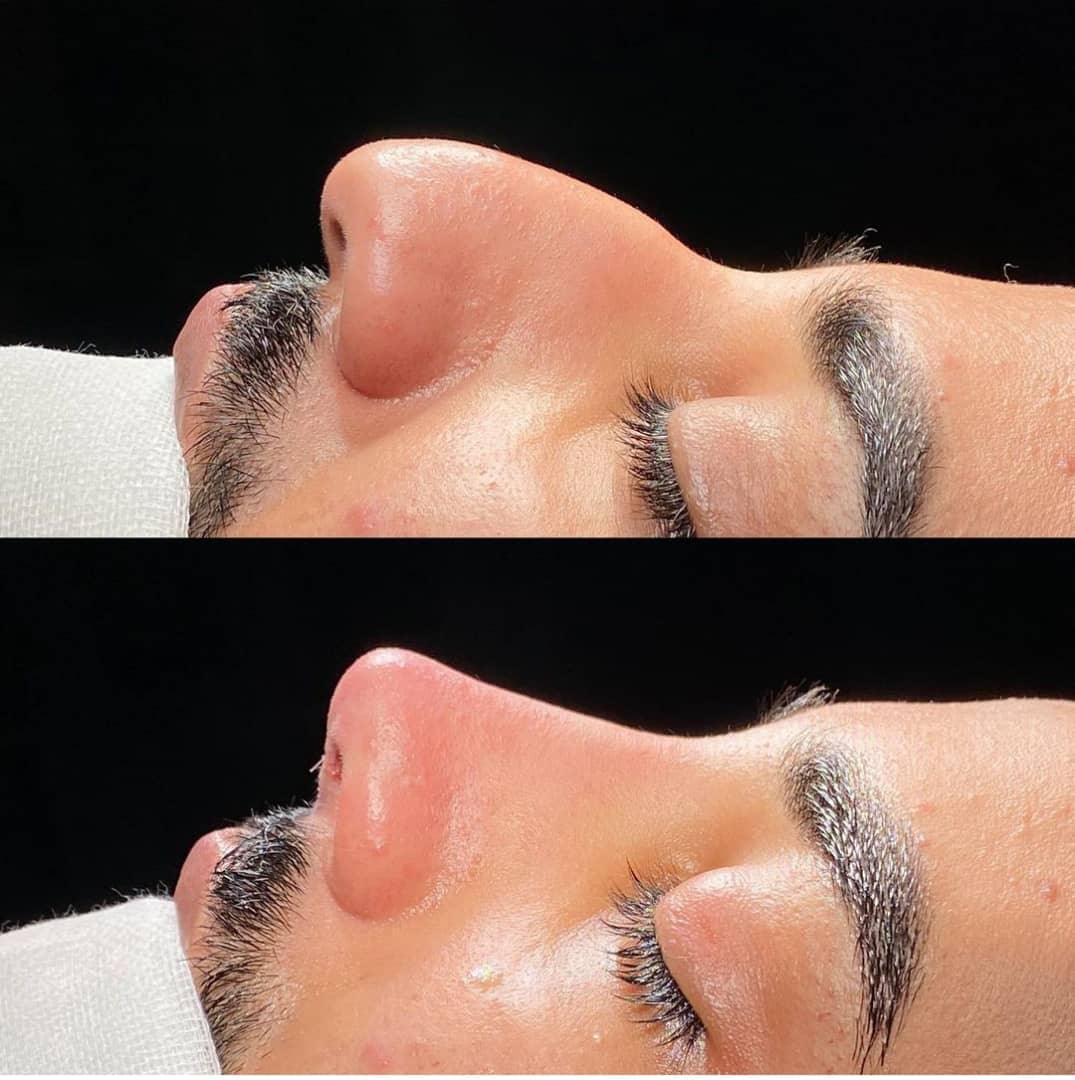 بینی گوشتی نیمه فانتزی؛ دکتر خسرو مقتدر | بهترین جراح بینی نیمه فانتزی در تهران