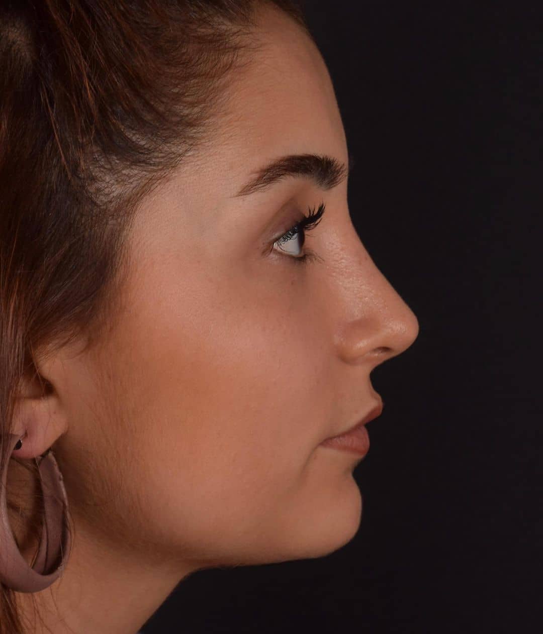 قبل و بعد نیمه فانتزی؛ دکتر خسرو مقتدر | بهترین جراح بینی نیمه فانتزی در تهران