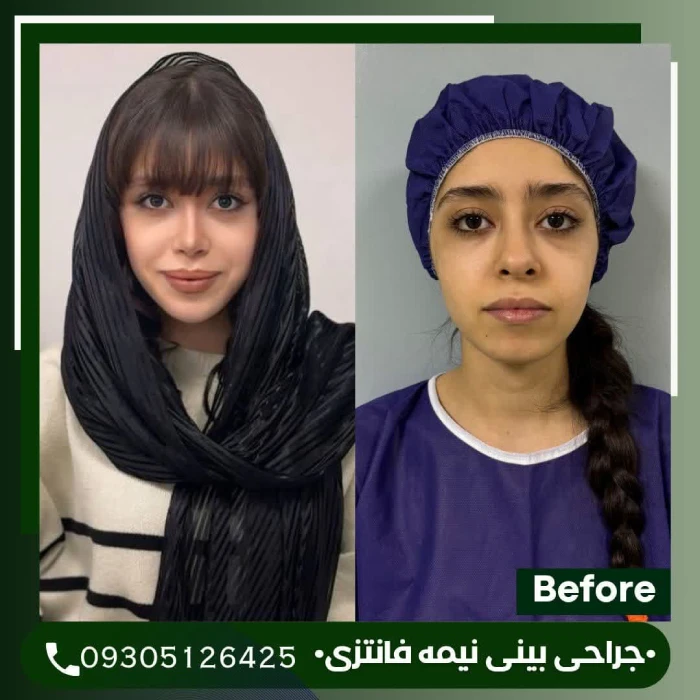 نتیجه ماندگار نیمه فانتزی؛ دکتر علی شکرریز | بهترین جراح بینی نیمه فانتزی در تهران