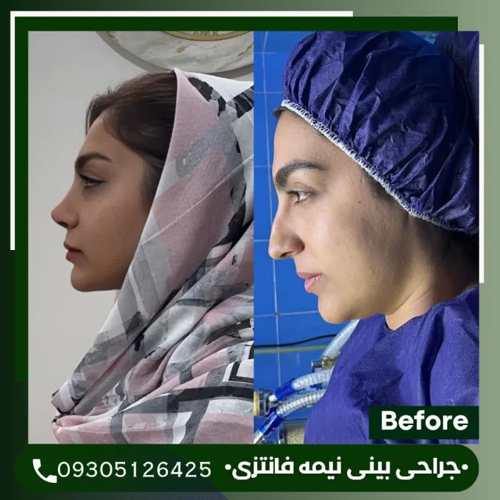 فرم متعادل نیمه فانتزی؛ دکتر علی شکرریز | بهترین جراح بینی نیمه فانتزی در تهران
