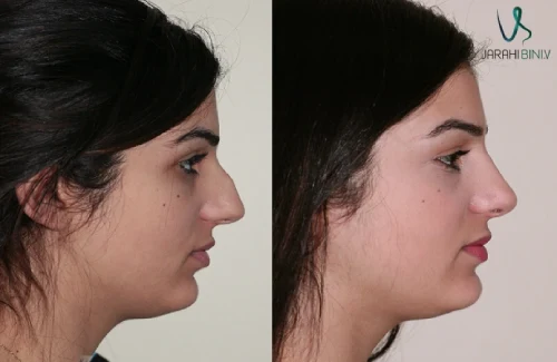 قبل و بعد نیمه فانتزی؛ دکتر علی شکرریز | بهترین جراح بینی نیمه فانتزی در تهران