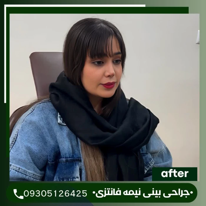طراحی اختصاصی نیمه فانتزی؛ دکتر علی شکرریز | بهترین جراح بینی نیمه فانتزی در تهران