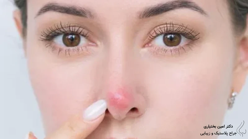 قرمزی نوک بینی بعد از عمل-