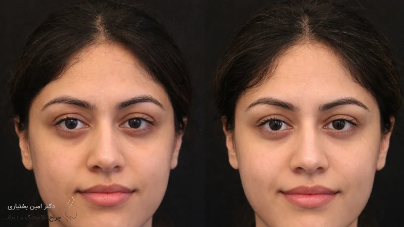 جراحی بینی بدون ایجاد جای زخم خارجی چیست؟