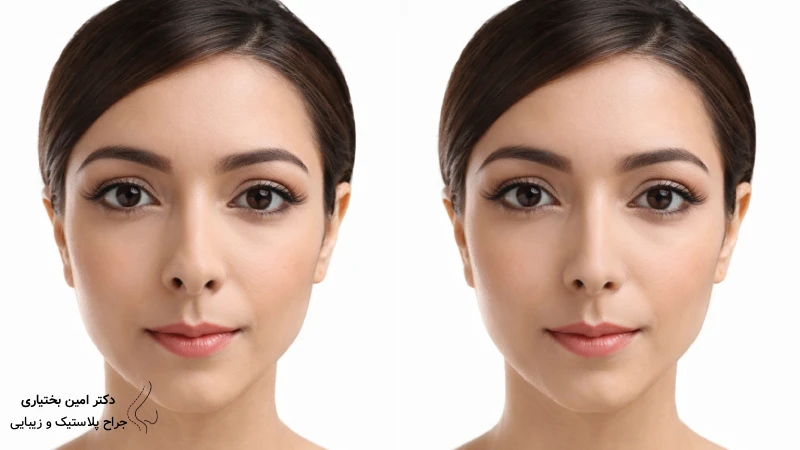 جراحی بینی بدون برش خارجی