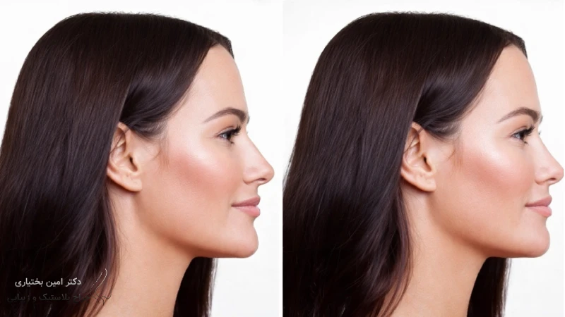 نکات مهم برای انتخاب جراح بینی بدون برش خارجی