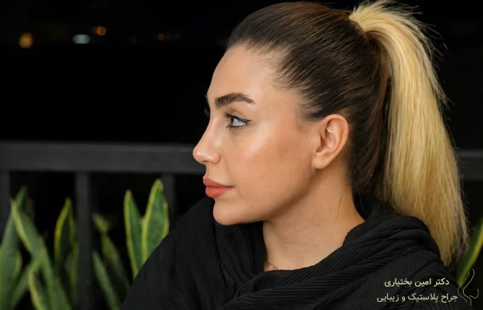 هزینه عمل بینی در تهران- دکتر امین بختیاری