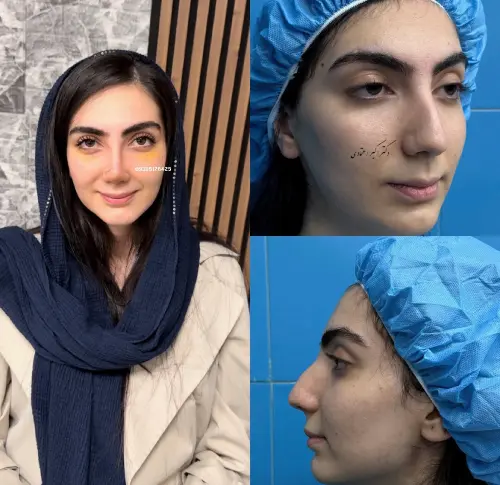 نمونه نتیجه جراحی بینی دکتر علی شکرریز با فرم طبیعی و تناسب چهره