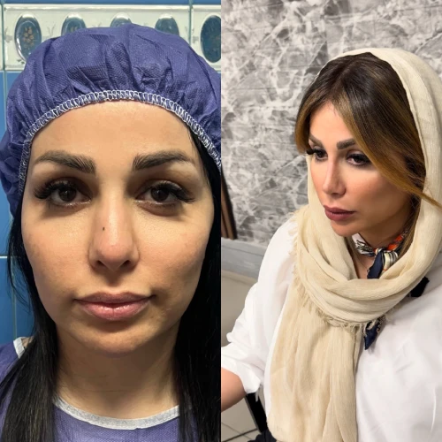 نمونه نتیجه طبیعی جراحی بینی دکتر خسرو مقتدر
