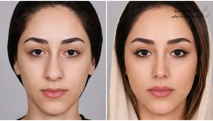 نمونه‌کارهای بینی گوشتی را چطور درست بررسی کنیم؟