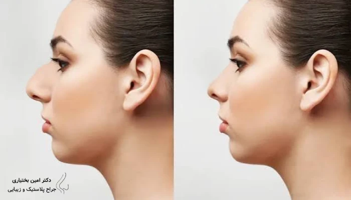 نتیجه جراحی بینی نیمه فانتزی زنانه از نمای نیم‌رخ با قوس ملایم و نوک متناسب