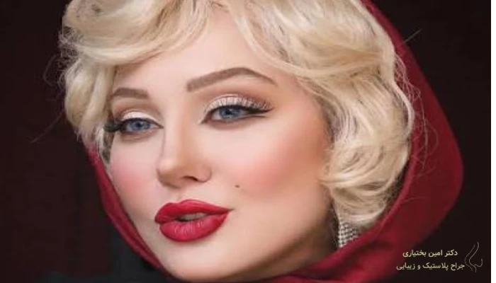 نتیجه جراحی ترمیمی بینی با بازسازی غضروف و بهبود فرم طبیعی بینی
