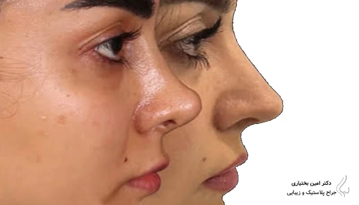مقایسه قبل و بعد جراحی بینی ترمیمی با اصلاح افتادگی و انحراف بینی
