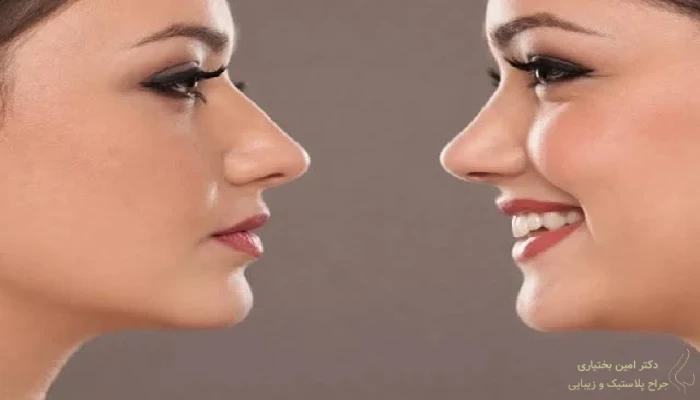 مقایسه قبل و بعد جراحی بینی طبیعی با اصلاح قوز و افتادگی نوک بینی