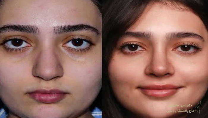 مقایسه قبل و بعد از جراحی زیبایی بینی