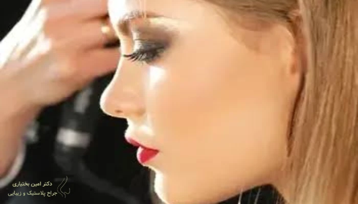 نتیجه جراحی بینی استخوانی نیمه فانتزی با فرم طبیعی و قوس کنترل‌شده