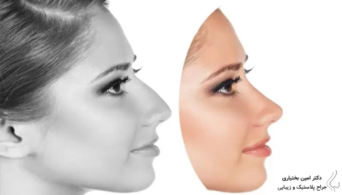 نتیجه جراحی بینی طبیعی از نمای نیمرخ با حفظ قوس ملایم بینی