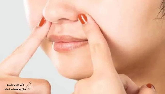 نتیجه جراحی بینی گوشتی با پوست ضخیم و تقویت غضروف نوک بینی