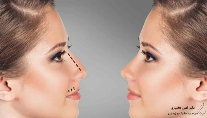 نمونه جراحی بینی طبیعی زنانه با فرم متناسب و بدون سربالایی زیاد