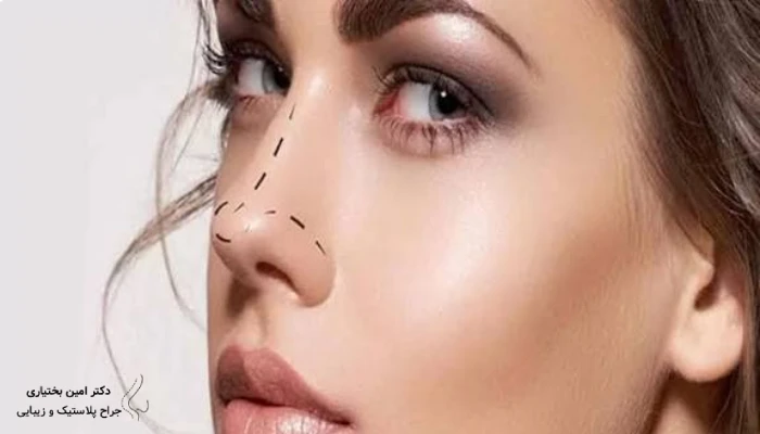 نمونه عمل بینی نیمه فانتزی از نمای روبه‌رو با فرم ظریف و متقارن