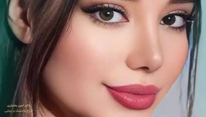 نمونه عمل ترمیمی بینی از نمای روبه‌رو با بهبود تقارن و پهنای بینی