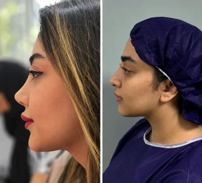عکس قبل از جراحی بینی گوشتی دکتر امین بختیاری
