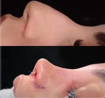 نمونه نتیجه جراحی بینی دکتر امیرحسین محمدی مفرد در تهران
