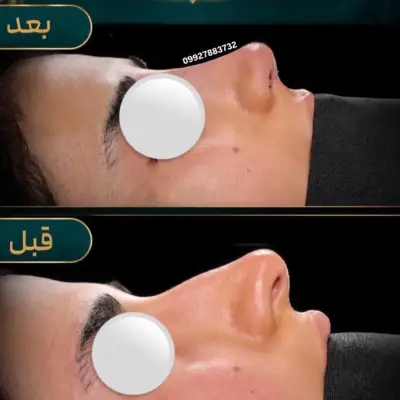 عکس قبل از جراحی بینی طبیعی دکتر امین بختیاری