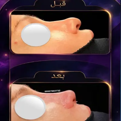 عکس قبل از جراحی بینی استخوانی دکتر امین بختیاری