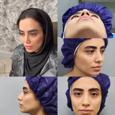 عکس بعد از جراحی بینی ترمیمی دکتر امین بختیاری