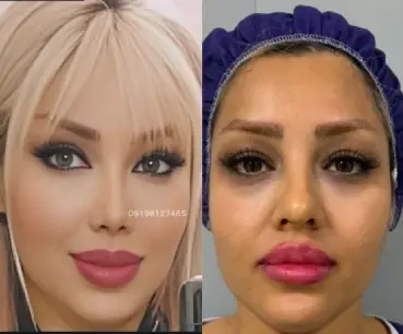 عکس بعد از جراحی بینی گوشتی دکتر امین بختیاری