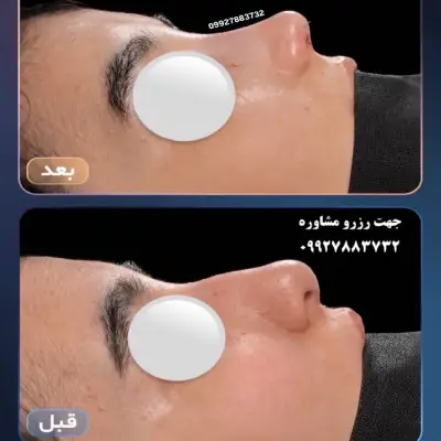 عکس بعد از جراحی بینی طبیعی دکتر امین بختیاری